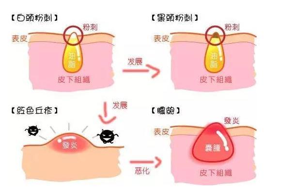 脸上的白点点怎么回事,脸上有白色脂肪粒是什么原因