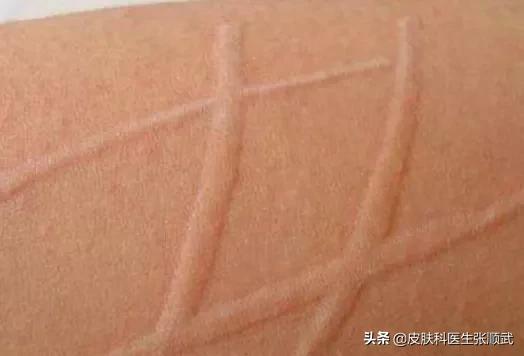 荨麻疹针刺消除的最佳方法,民间治疗荨麻疹最好的方法