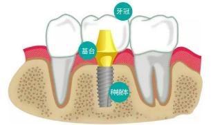 牙槽骨高了怎么做种植牙,牙槽骨少可以种植吗