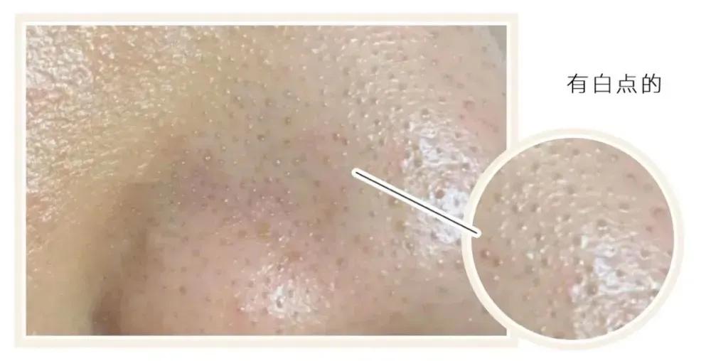 黑头用黑头贴去不掉怎么办,白糖去黑头的正确方法