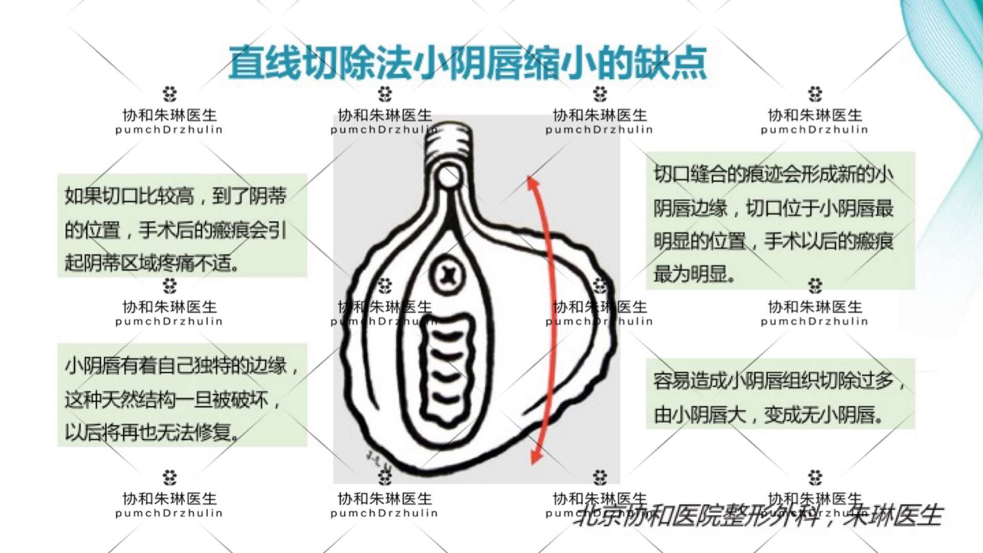 外阴一边大一边小手术怎么做,外阴不规则可以做手术吗