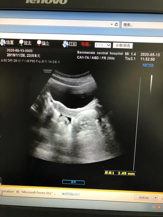 儿童性早熟要做哪些检查？怎么根据这些指标判断真性还是假性？