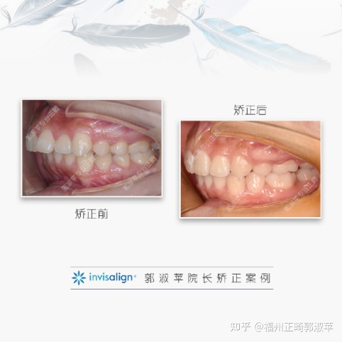 牙齿龅牙矫正过程全记录33岁,大龅牙牙齿矫正成功案例和费用