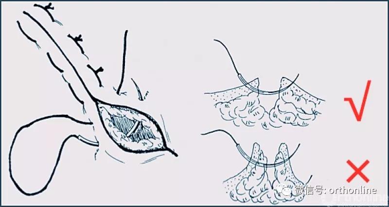 常用的手术缝合方法图,临床常见常用伤口缝合方法
