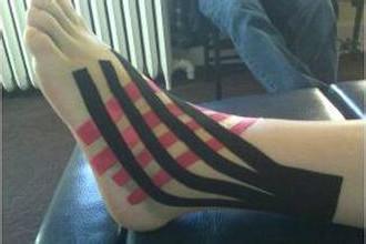 浅谈踝关节扭伤与创伤性关节炎,踝关节扭伤包扎