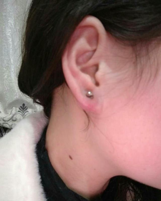 中医为什么不建议打耳洞,为什么不建议打激光耳洞