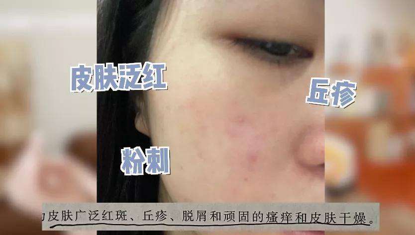 抗炎痘痘,痘痘肌抗炎产品