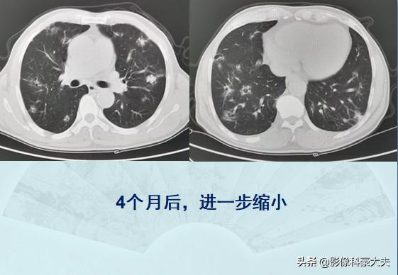 癌症晚期肺转移还能活多久,肺癌症晚期能有必要化疗吗