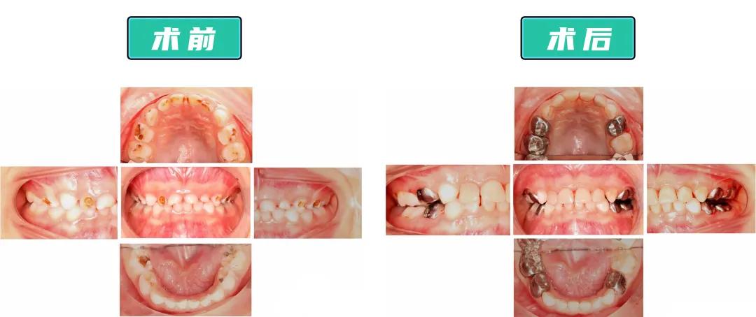 四岁小孩20颗蛀牙视频,4岁孩子蛀牙不痛有必要去补牙吗