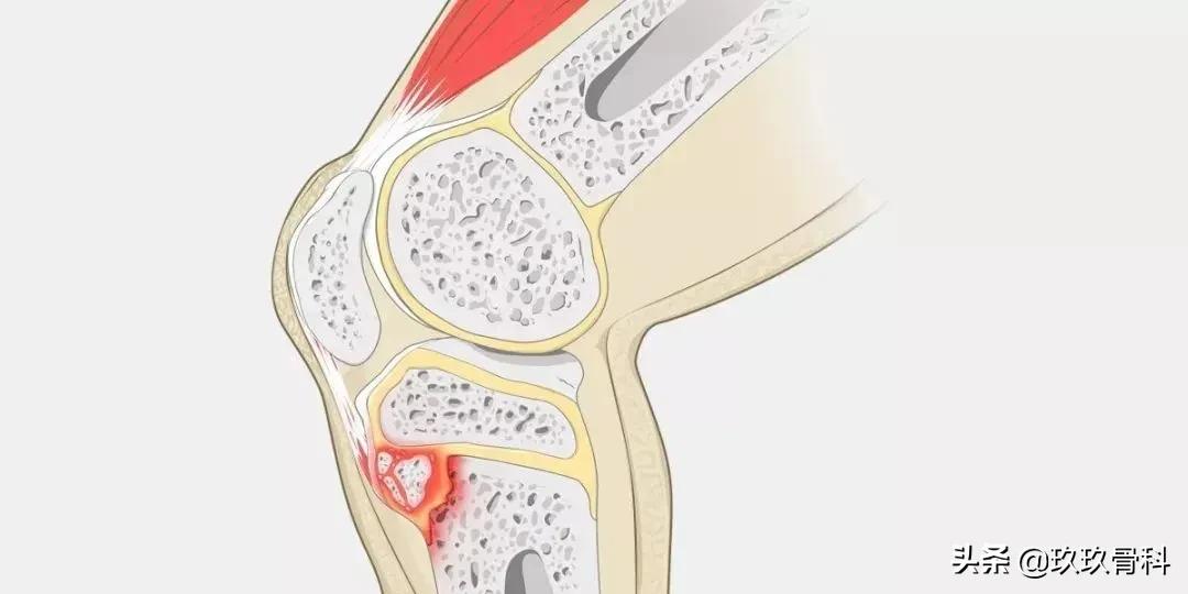 青少年膝盖疼骨骺炎怎么缓解,胫骨结节骨软骨炎怎么缓解疼痛