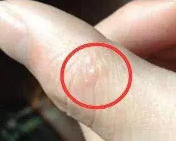 天气一热手上长水泡脱皮,每年天热手上会长小水泡特别痒