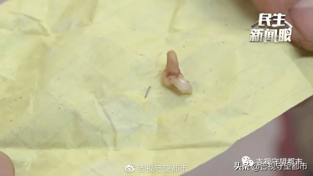 针管治疗中牙一直疼,牙里藏一根针可以治好吗