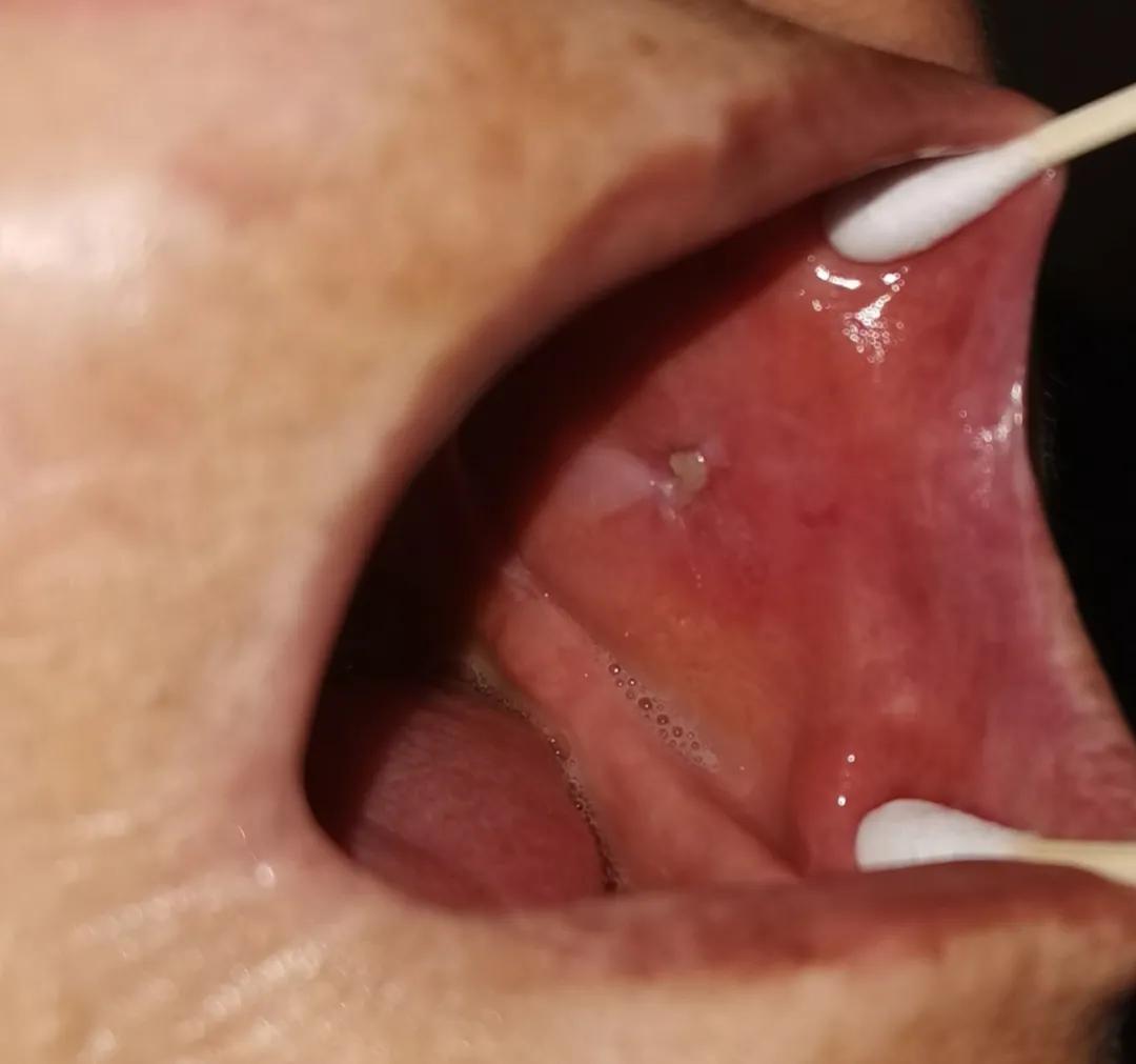 口腔溃疡最后发现是癌症故事,口腔溃疡竟是由这些原因引起的
