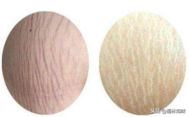 产后妊娠纹的简单去除方法超有效,产后宝妈如何运动可以消除妊娠纹