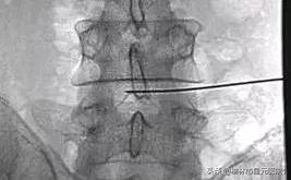 榆林佳县治疗腰椎间盘突出,榆林腰椎间盘突出最有效治疗