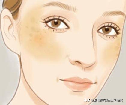 治疗褐斑的最佳方法,褐斑如何确诊