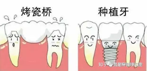 种植牙与烤瓷牙的区别,烤瓷牙和种植牙到底有何区别