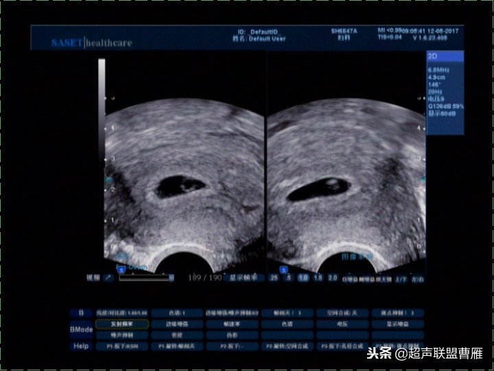 3毫米卵黄囊未见胎芽正常么,40多天的卵黄囊