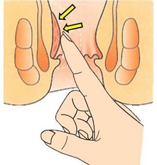 内痔用什么药效果更快,什么是外痔什么是内痔