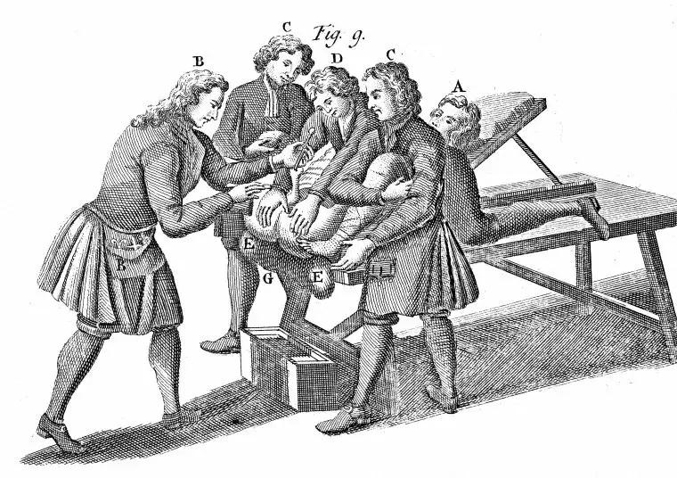 从尿道口取结石全过程,最先进的结石处理方法