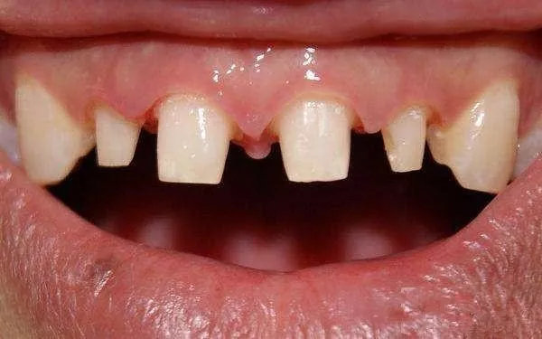 看牙花50万,看牙花了2000块钱