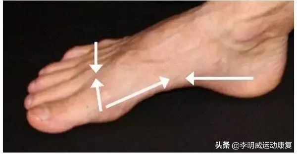 足外翻能不能治愈,足外翻能自己长好吗