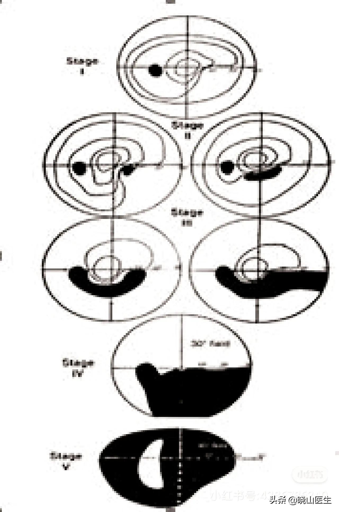 眼底检查塌陷,眼底筛查充血