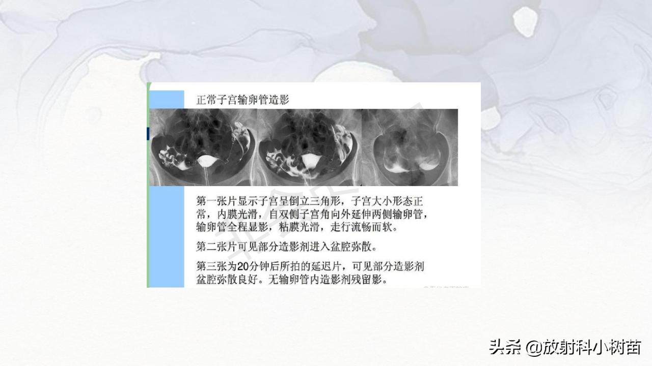 女性盆腔mri解剖图谱,泌尿生殖系统x线解剖
