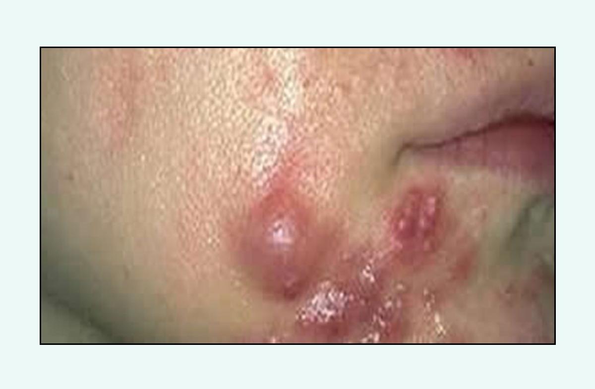 脸上的红疙瘩怎么彻底消除,脸上红疙瘩的种类