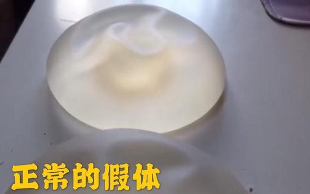 假体隆胸坏死,女子隆胸30年的假体突然破