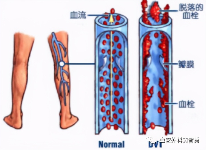 血栓状态保胎到什么时候安全,怀孕卧床保胎容易得下肢静脉血栓