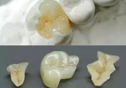 严重的蛀牙怎么修复,轻微的蛀牙修复全过程