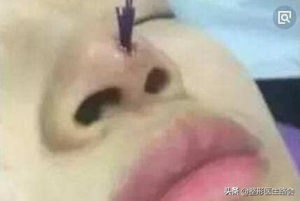 线雕隆鼻做出来不平,线雕隆鼻为什么没什么改变