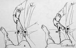 膝关节内侧副韧带损伤的诊疗进展,膝关节内侧副韧带损伤的正确叙述