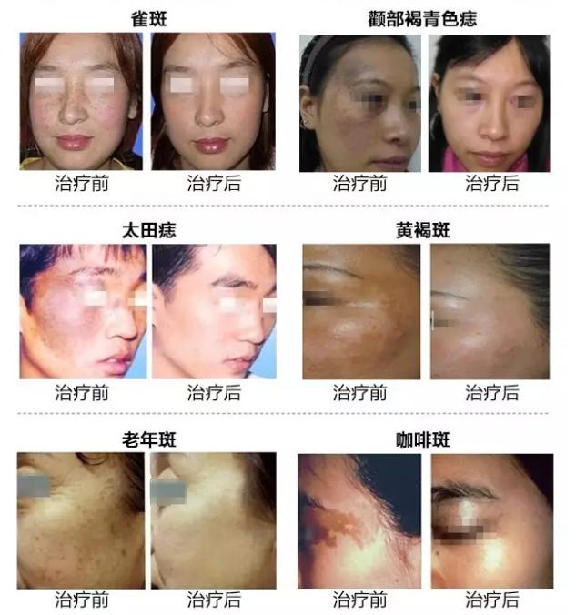 激光皮秒祛斑为什么会反黑,皮秒激光祛斑后怎么预防反黑