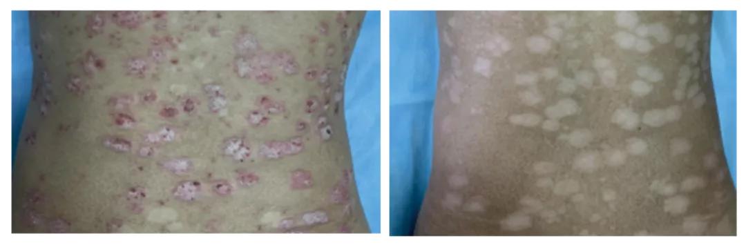 北京大学滨海医院皮肤科开设银屑病专病门诊