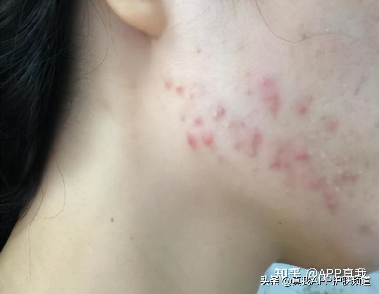 敏感肌刷酸刷多了会变成怎样,敏感肌刷酸后皮肤变红