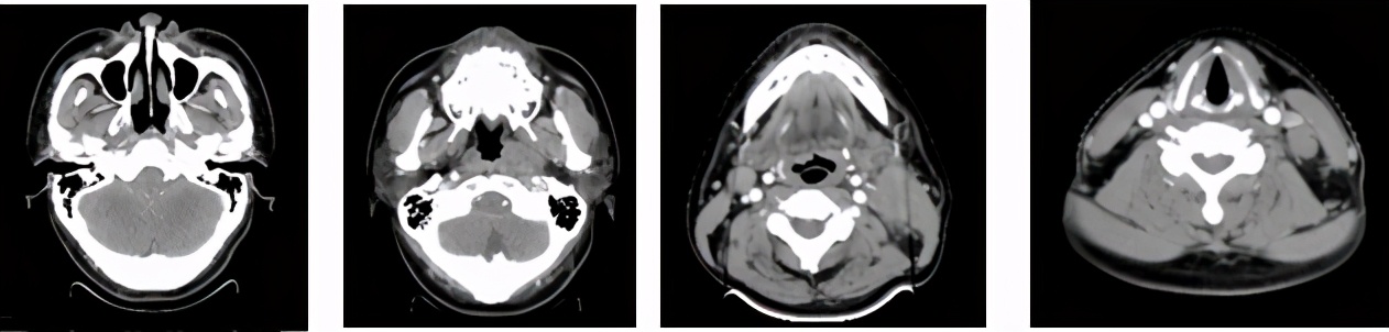 pd-1抑制剂适用的肿瘤类型,pd-1抑制剂能用于癌症晚期么