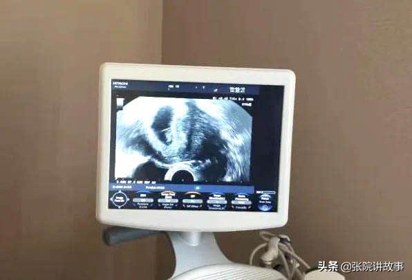 「张院讲故事」一直“通畅”的输卵管，为啥突然就功能异常了？