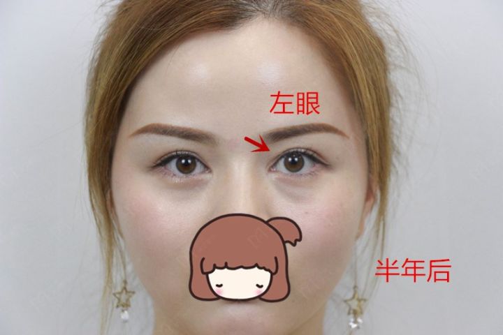 为什么有人割了双眼皮反而不好看,为啥有些人割了双眼皮变化巨大