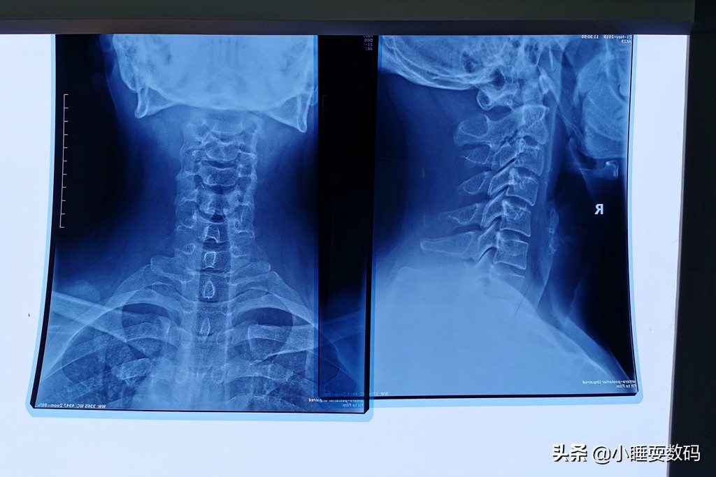 有颈椎病适合用什么类型的枕头,最好的保护颈椎的专用枕头推荐