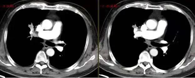 肺内见多发小囊状无纹理透光影,肺内肿块并厚壁空洞