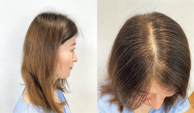 40岁女人头顶脱发严重怎么办,女人头顶有旋头发很少怎么处理