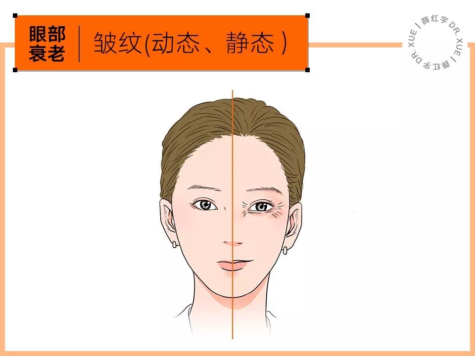 眼部抗衰最好方法,眼部抗衰效果图