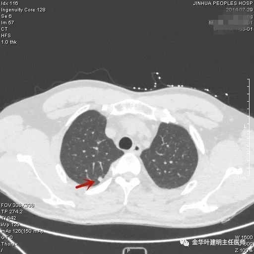 叶建明谈胸膜下的实性结节,叶建明肺实性良性结节会变癌症吗