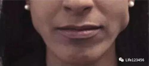 关于瘦脸你不知道的,瘦脸针可以解决发腮的问题吗