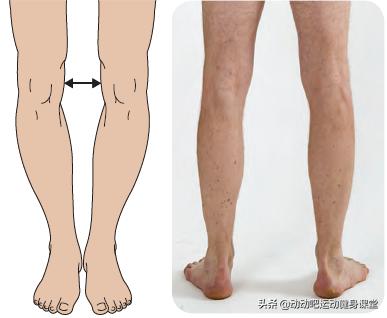 o型腿的赶紧看过来,o型腿有多丑
