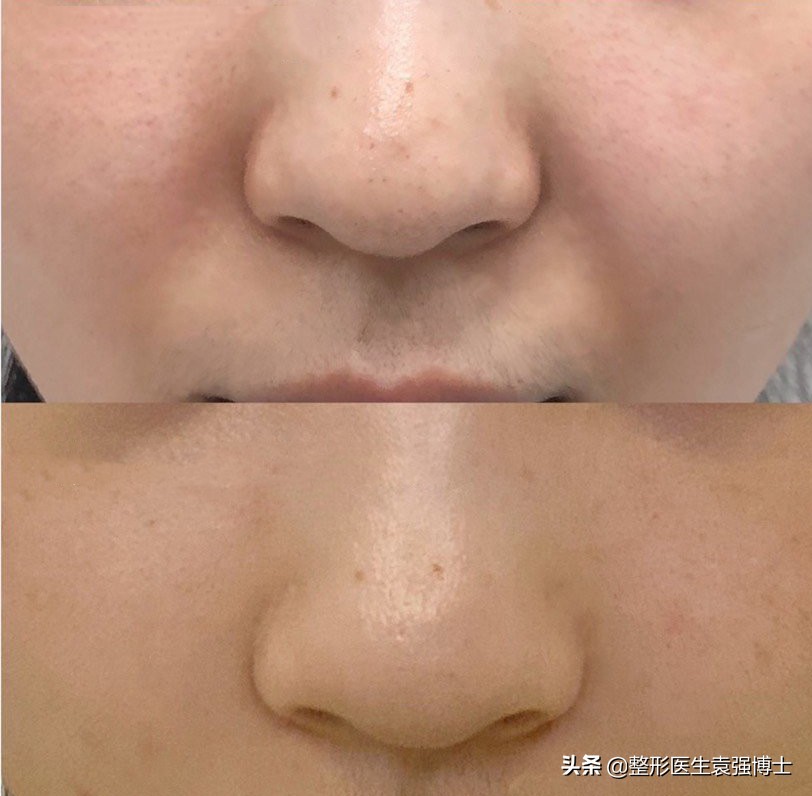 法令纹真正有效的方法,法令纹用什么方法解决比较好