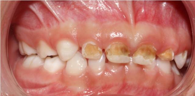 宝宝嘴里有白色的小点叫什么,一个月宝宝口腔上颚白色的是什么