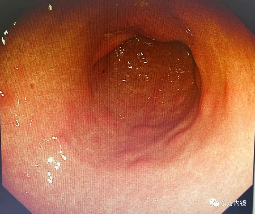 慢性浅表萎缩性胃炎怎么是轻度的,慢性浅表性胃炎中医治疗